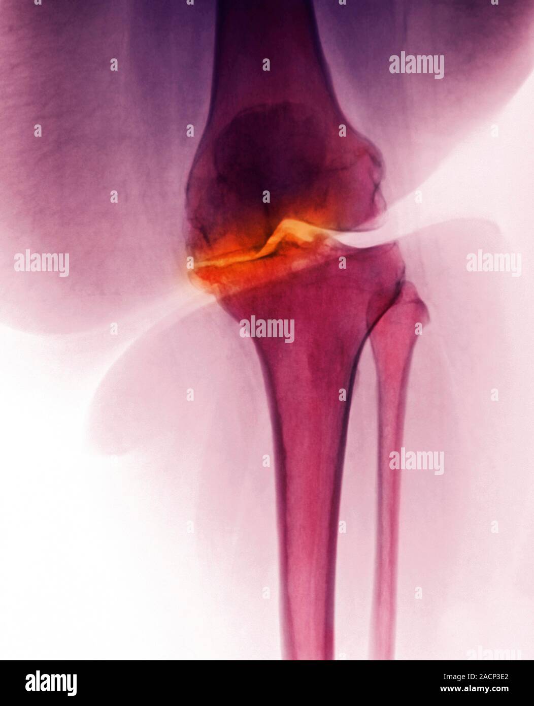 Arthritis of the knee. Coloured Xray of the knee of an obese 57 year