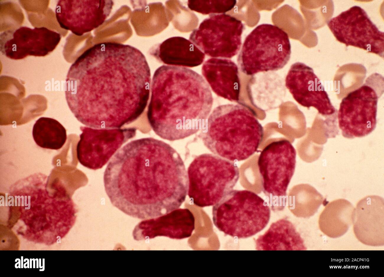 Acute leukaemia. Light micrograph of blood cells from bone marrow in a case of acute leukaemia. Leukaemia is a cancer where certain blood cells form i Stock Photo