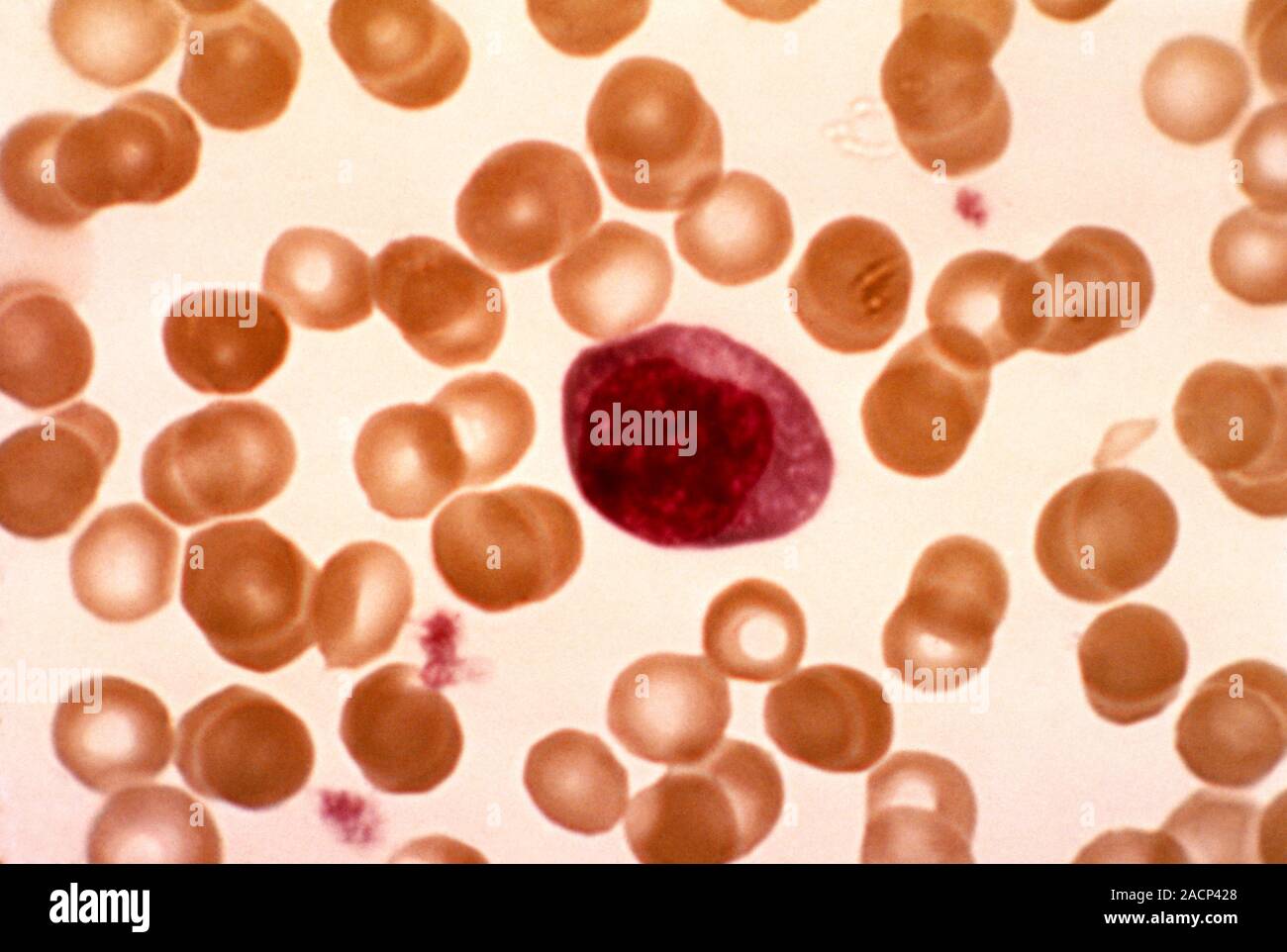 Infectious mononucleosis. Light micrograph of blood cells obtained in a case of infectious