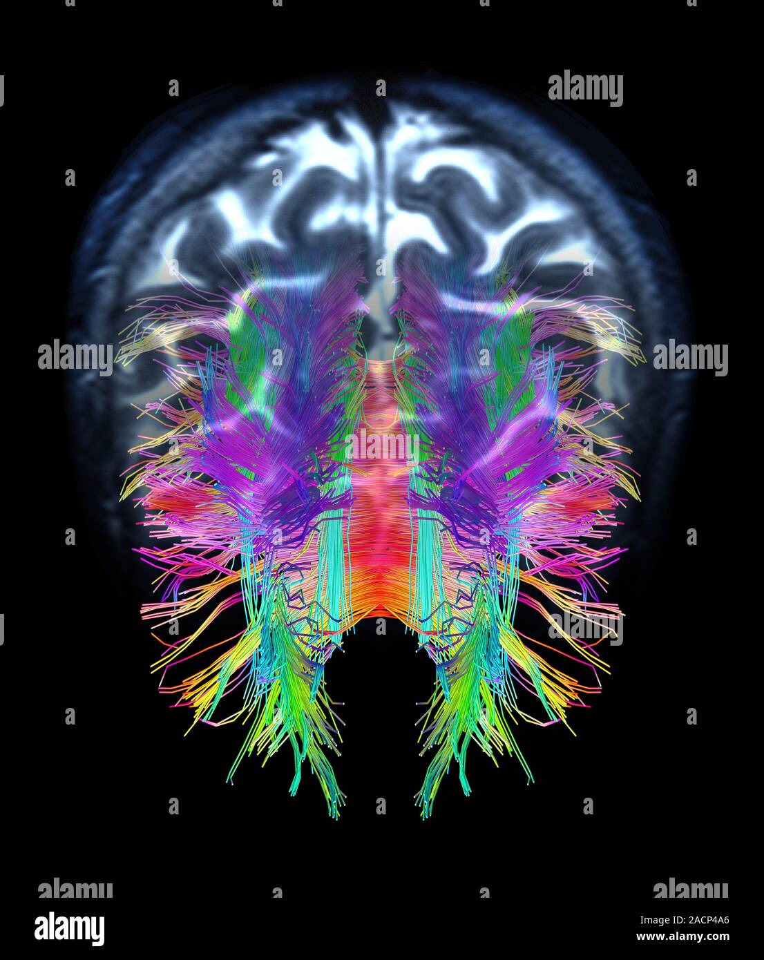 White matter fibres overlaid a 3d model of the human brain in top view ...