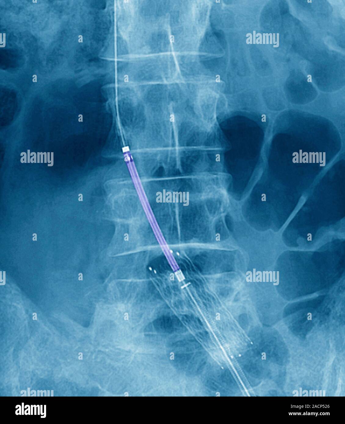 Balloon angioplasty. Coloured Xray of the abdomen of a 45yearold