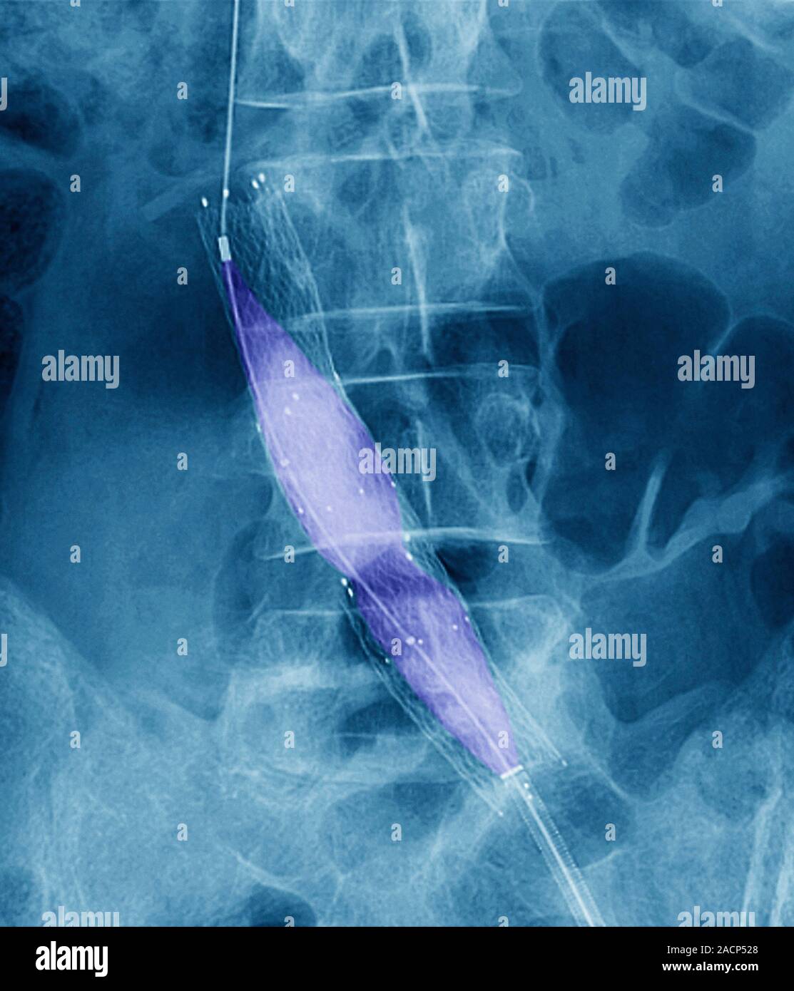 Balloon angioplasty. Coloured Xray of the abdomen of a 45yearold