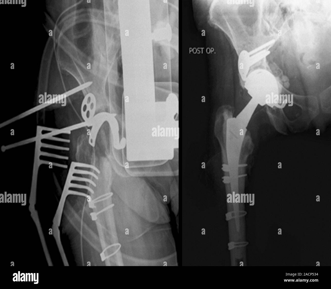 Total hip replacement. Xrays taken during (left) and after (right