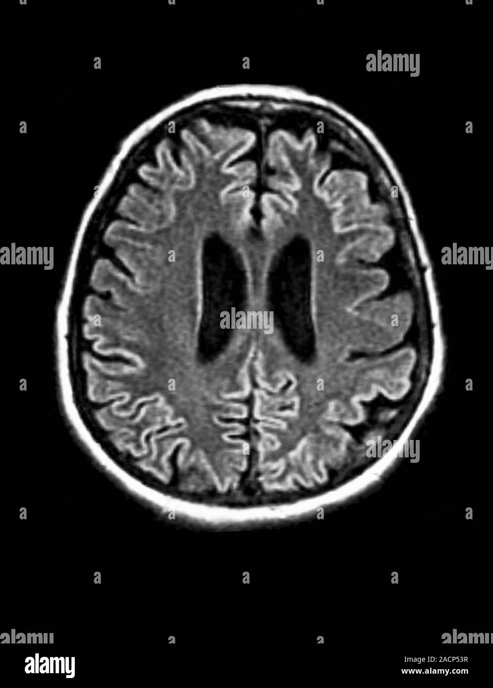 CreutzfeldtJakob disease. resonance imaging (MRI) scan of an