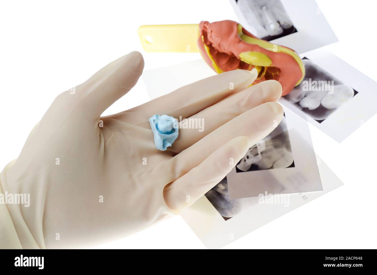 Cast For Tooth Dental cast. Close-up of a dentist holding the cast of a human tooth ...
