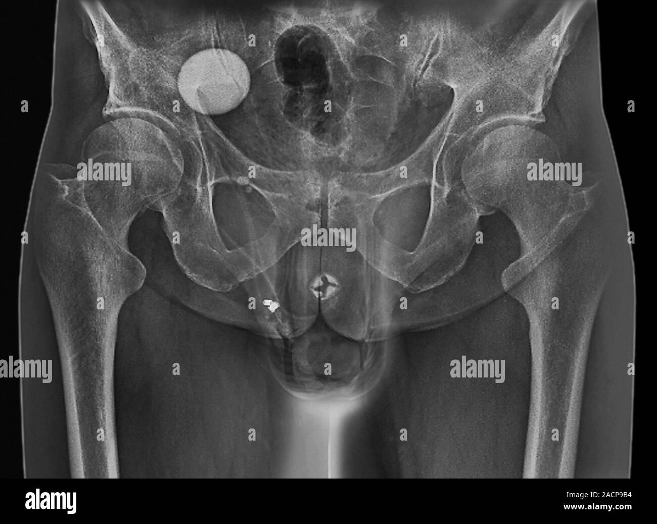Incontinence implant. Frontal Xray of the pelvic region of a 62year