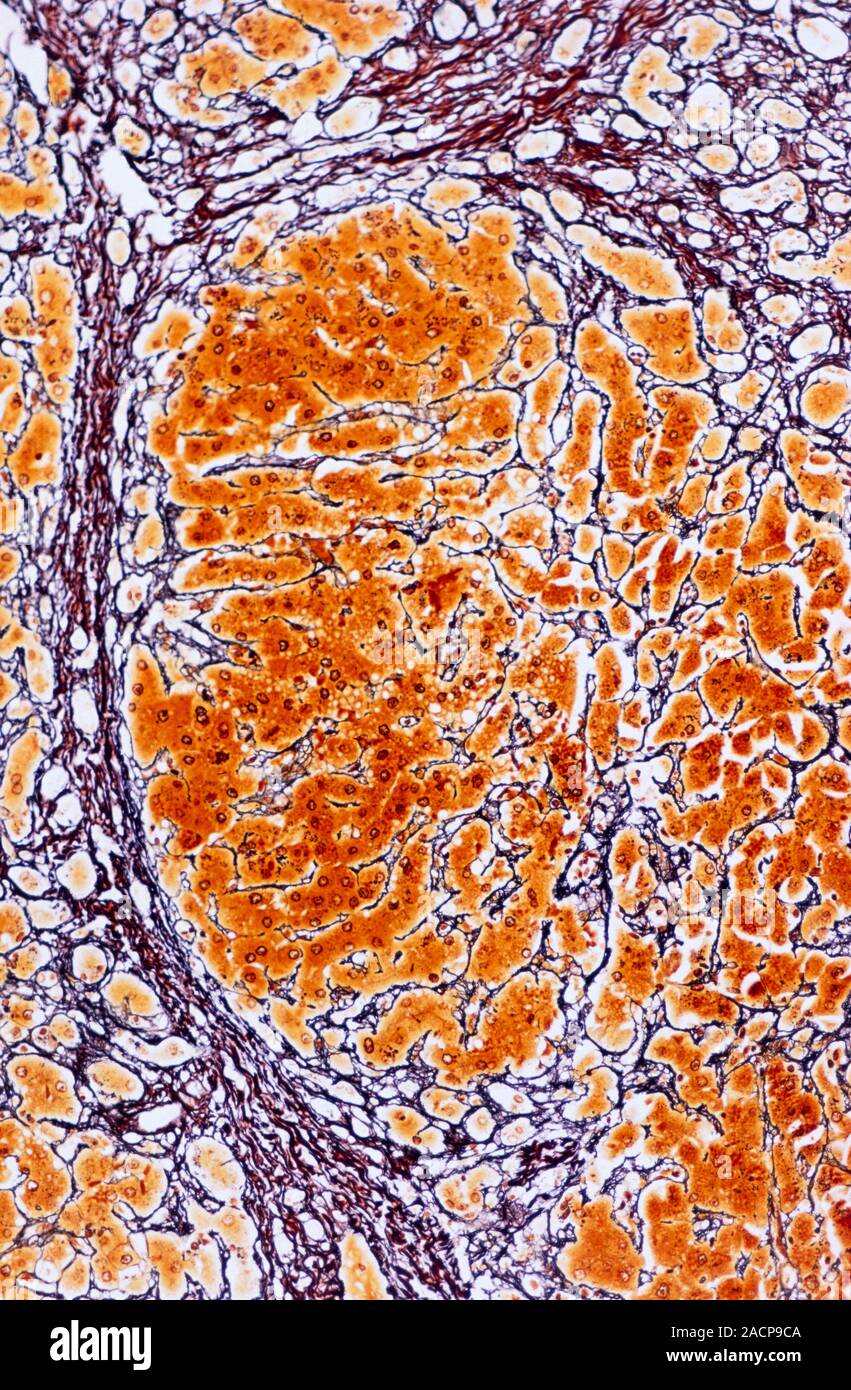 Cirrhosis of the liver. Light micrograph of a section through liver tissue affected by cirrhosis, showing a cluster of hepatocyte cells (orange) encir Stock Photo