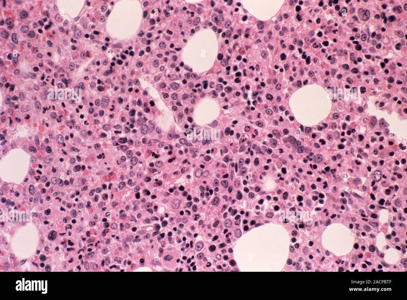 Acute myeloid leukaemia. Light micrograph of bone marrow from a patient ...