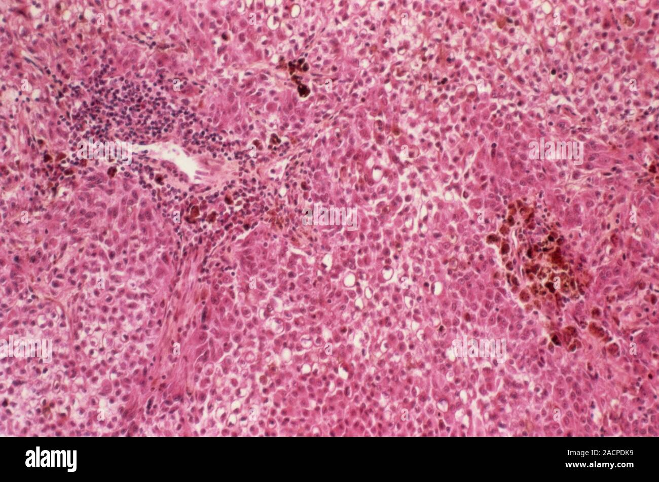 Metastatic melanoma. Light micrograph of a section through a lymph node ...