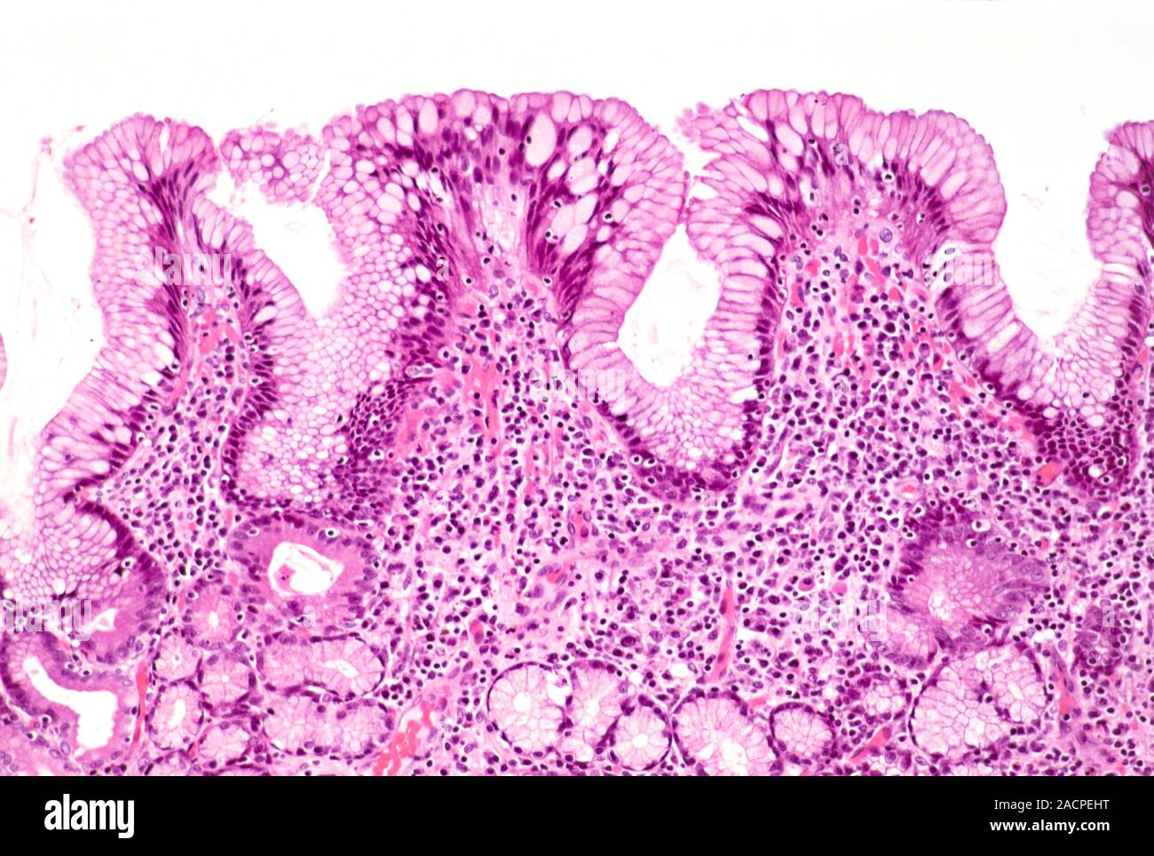 Gastritis. Light micrograph of a section through an inflamed human stomach (gastritis), showing