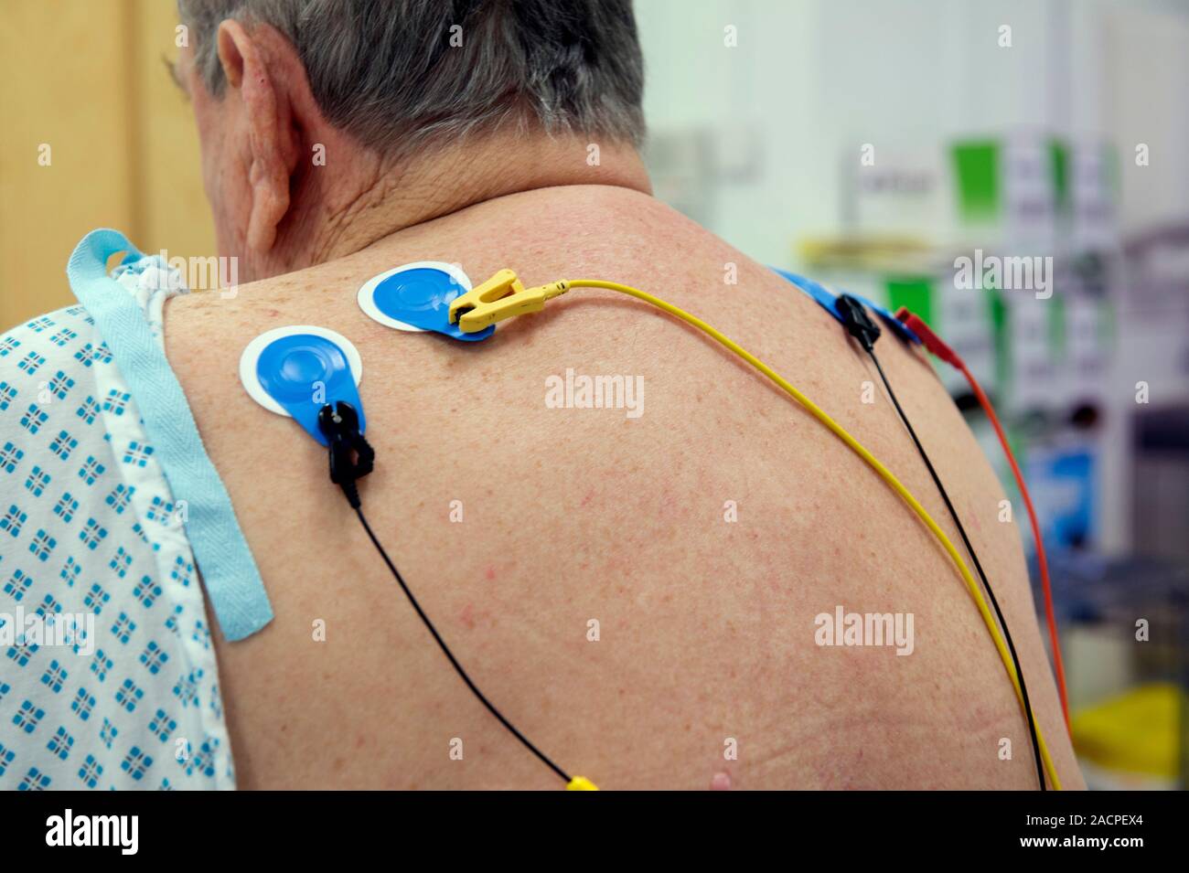 Heart monitoring. Patient with electrocardiogram (ECG) electrodes on