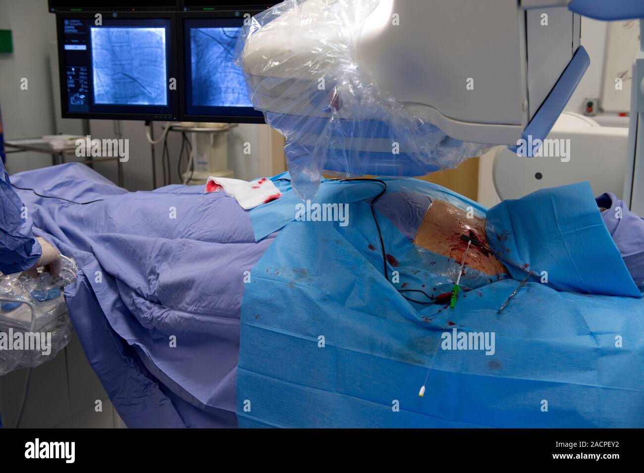 Implantable defibrillator surgery. Angiography being used during surgery to fit a biventricular