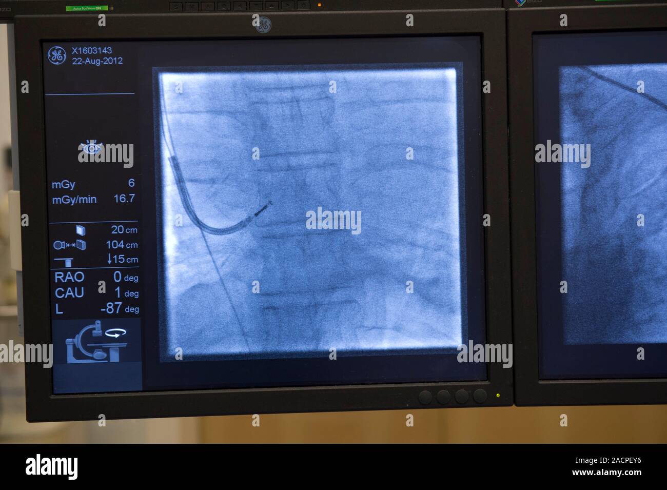 Implantable defibrillator surgery. Angiography being used during