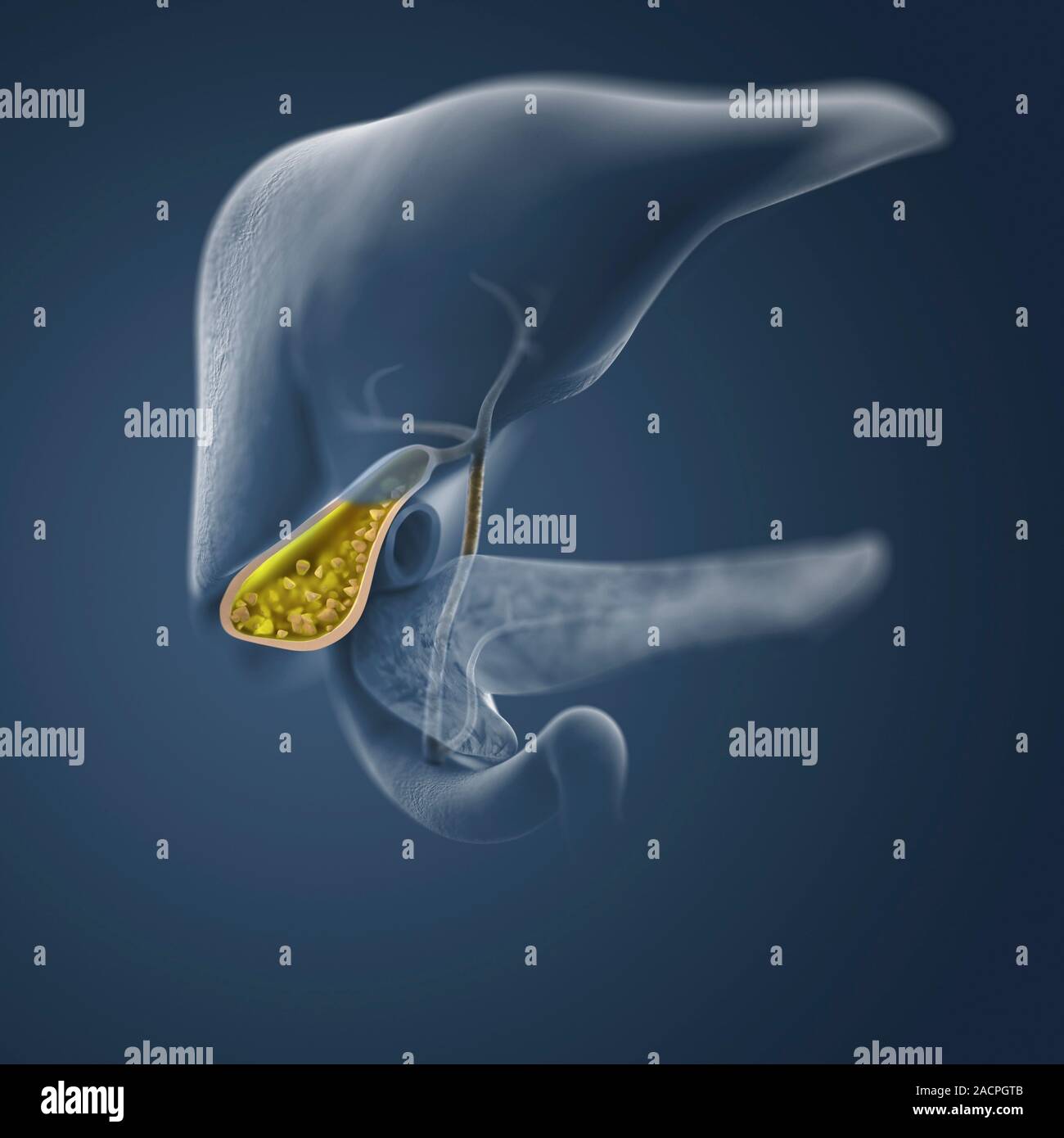 Gallstones. Artwork of the gallbladder (yellow), ducts, and surrounding