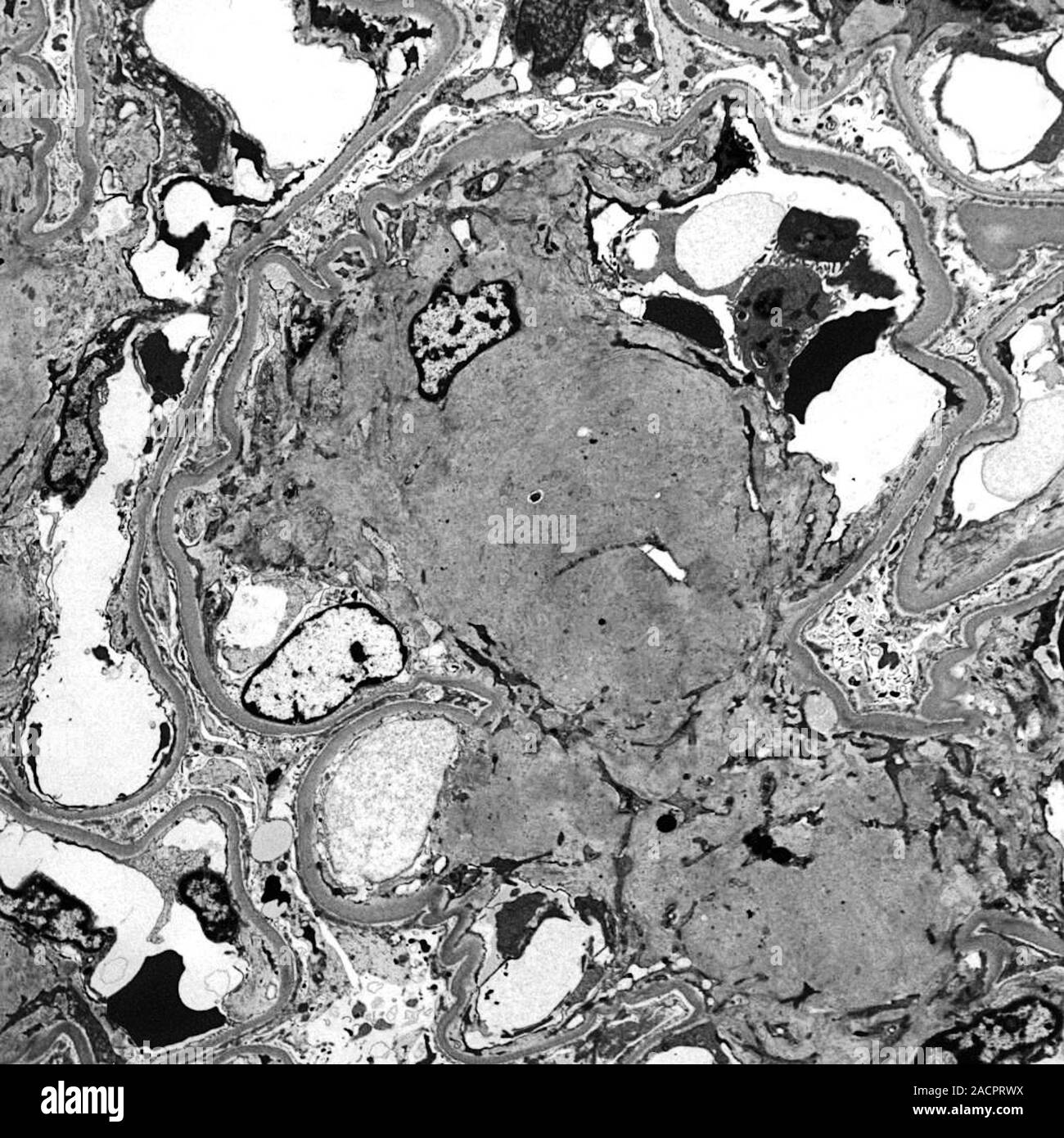 Glomerulosclerosis. Transmission electron micrograph (TEM) of a section