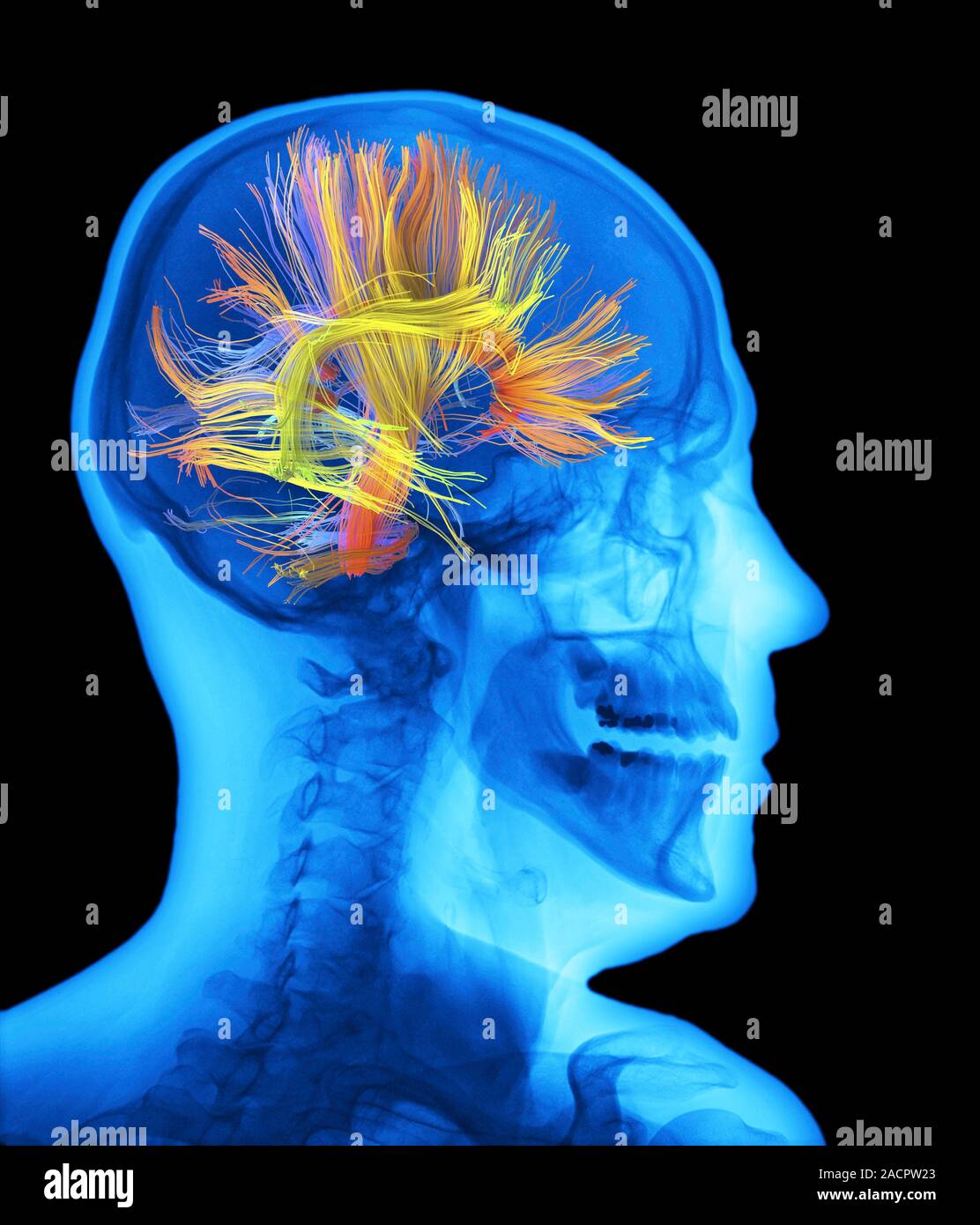 White matter fibres overlaid a human head x-ray. Coloured 3D diffusion ...
