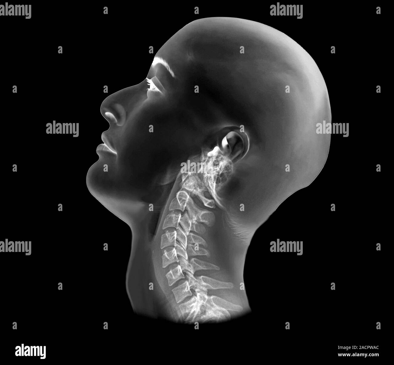 Normal extended neck. Xray of a 35 year old patient's healthy extended cervical (neck) spine