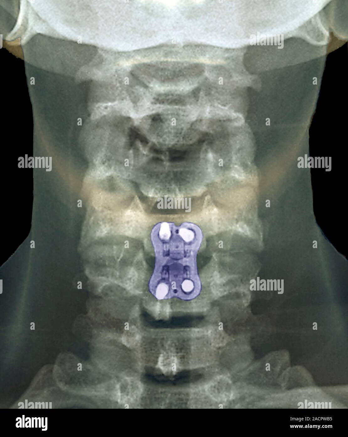 Neck arthritis treatment. Coloured Xray of the neck of a 48 year old