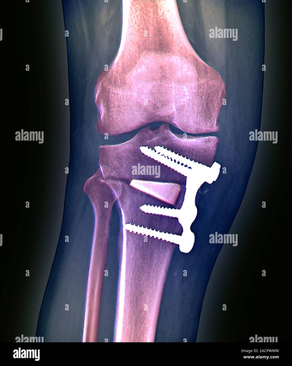 Knee alignment surgery. Coloured Xray of the knee of a 55 year old