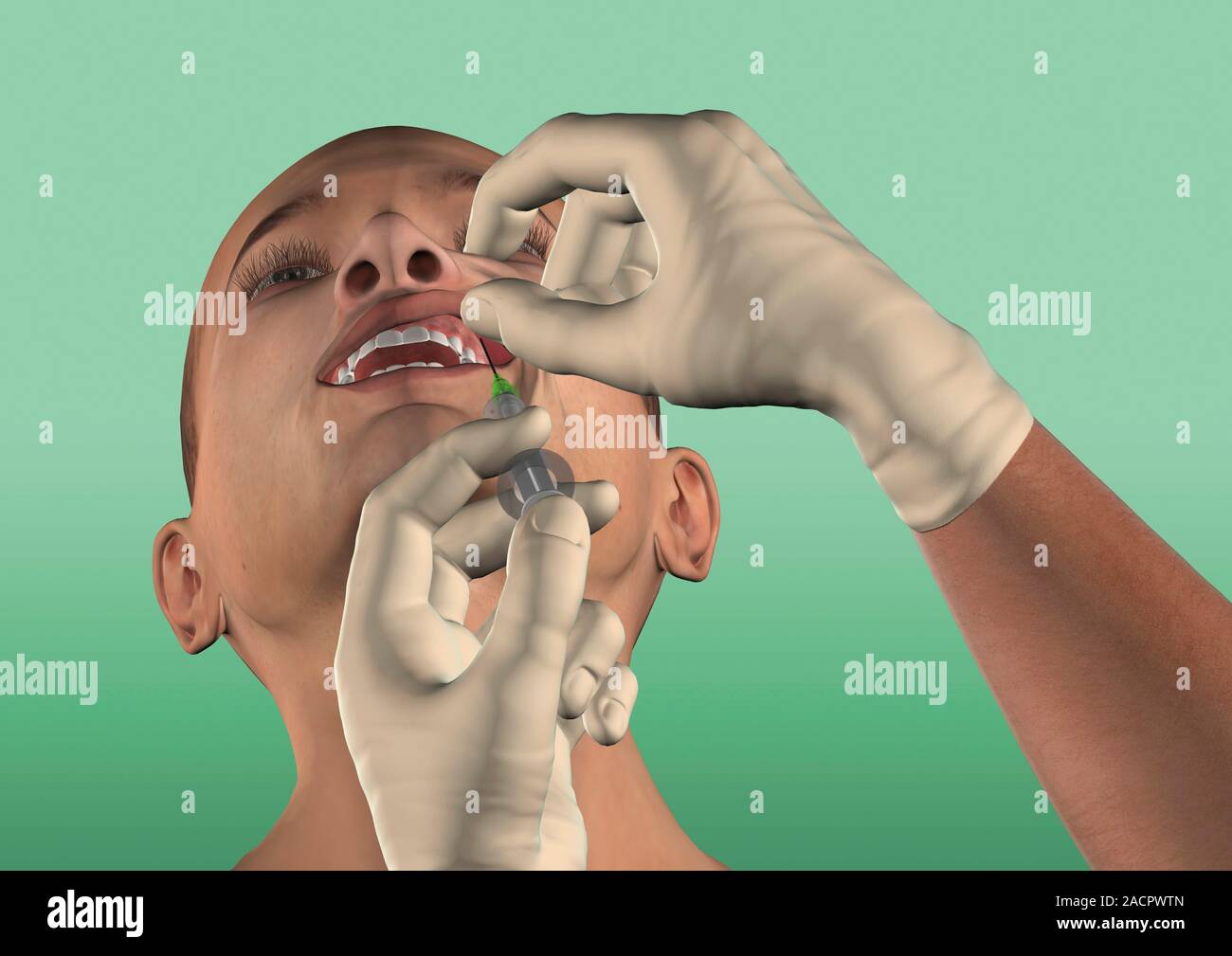 Infraorbital nerve block. Artwork of a syringe being used to inject a