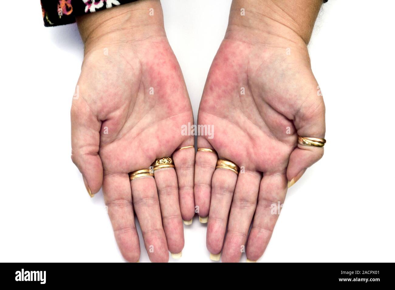 Not for use in Television Not for use in Television Rash (erythema) on ...