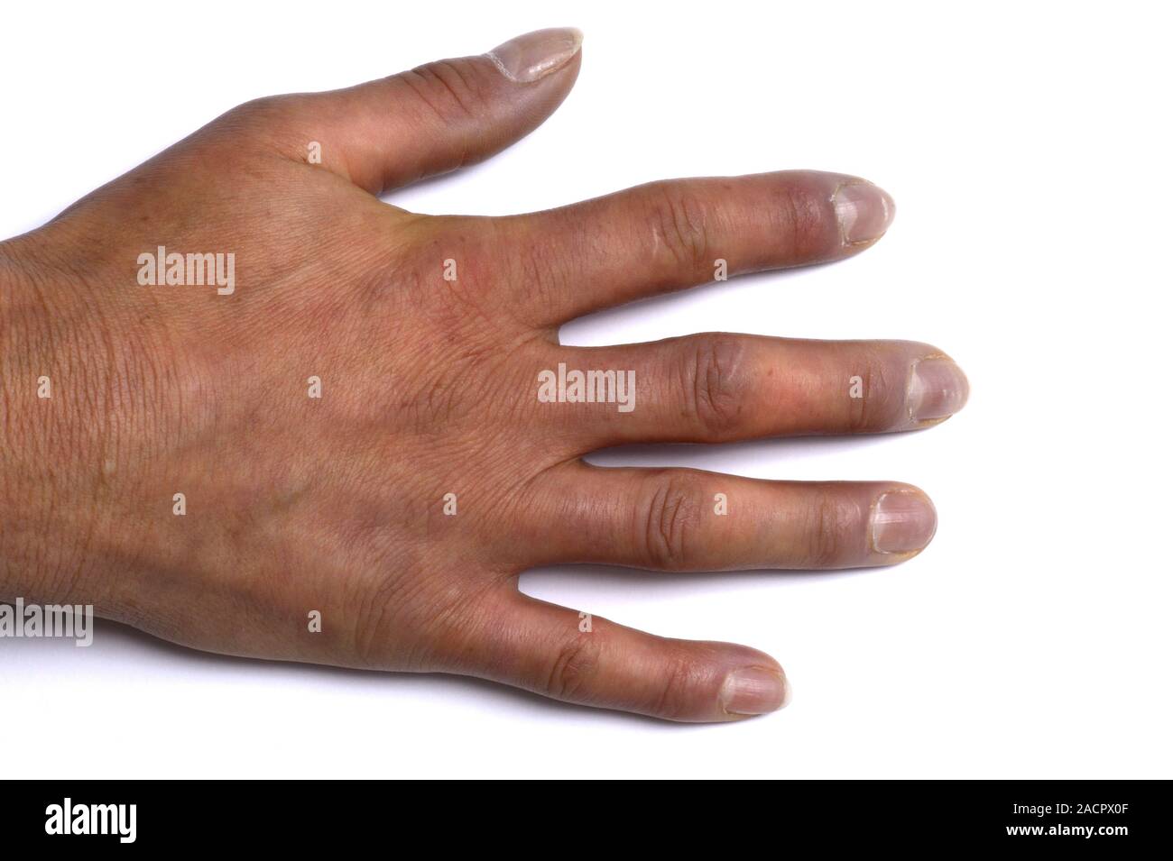 Not for use in Television Not for use in Television Scleroderma of the