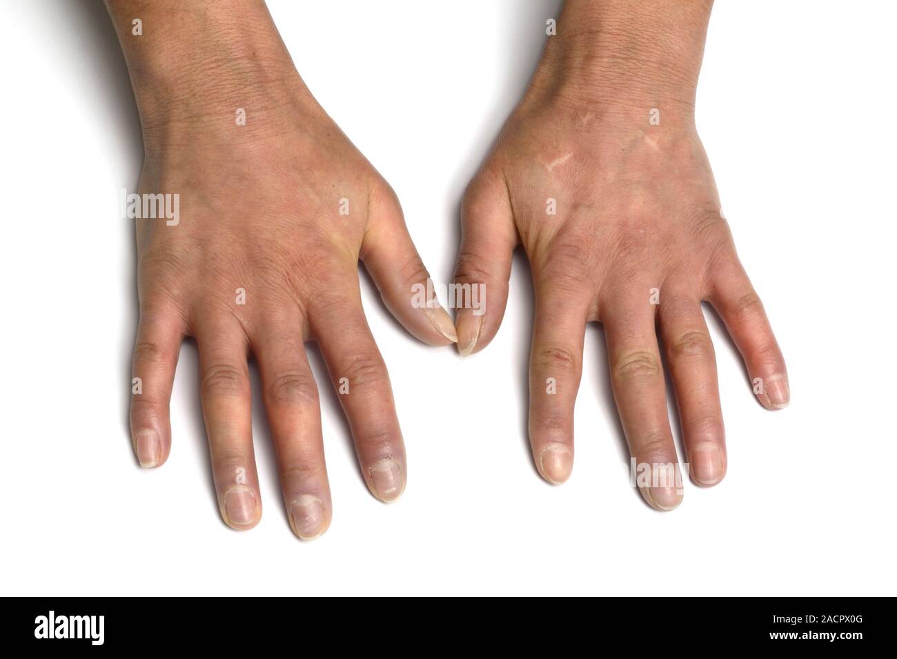 Not for use in Television Not for use in Television Scleroderma of the