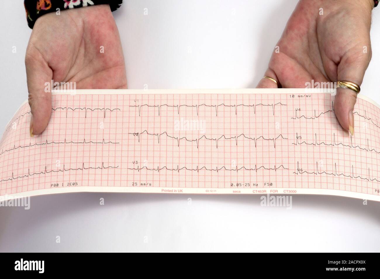 Not for use in Television Not for use in Television Palmar erythema and ...