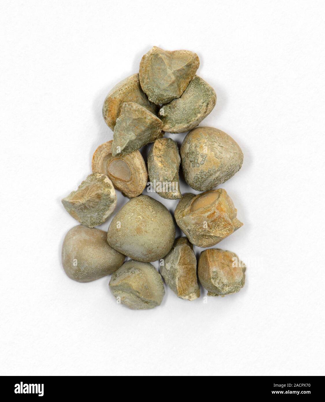 Not for use in Television Kidney stones. Assorted kidney (renal) stones