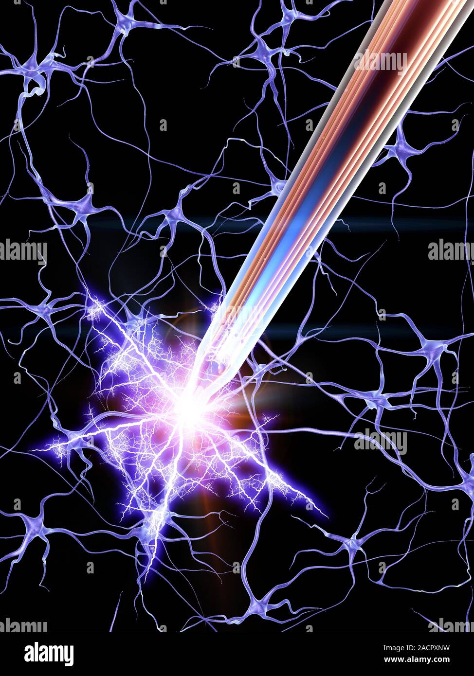 Deep brain stimulation (DBS). Computer artwork showing an electrode ...