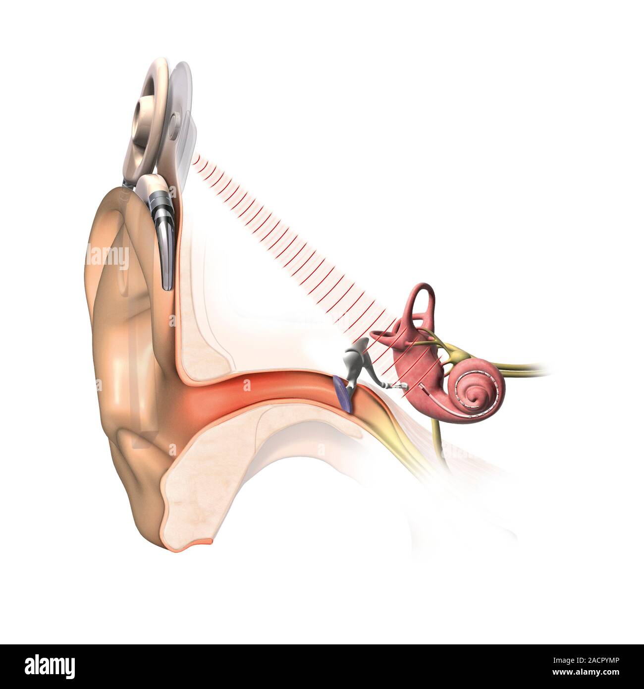 Cochlear implant. Computer artwork of a section through the outer (left ...