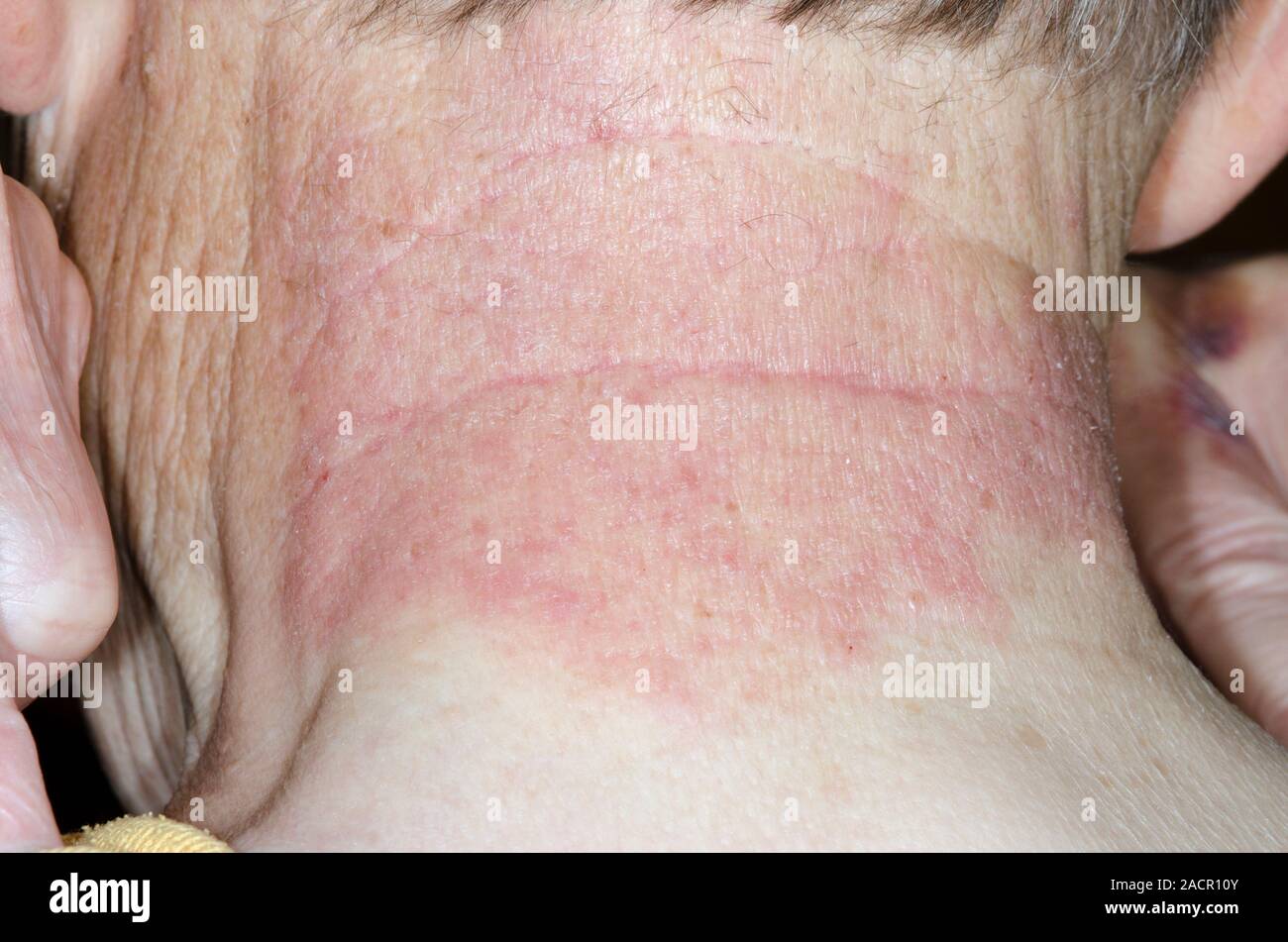 Red and flaky skin on the neck of an 84 year old male patient with contact dermatitis, a skin