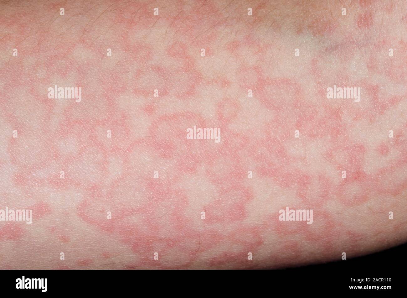 Rash of red wheals on the skin of an 11 year old male patient, an urticarial reaction to the viral infection slapped cheek disease. Urticaria (hives o Stock Photo