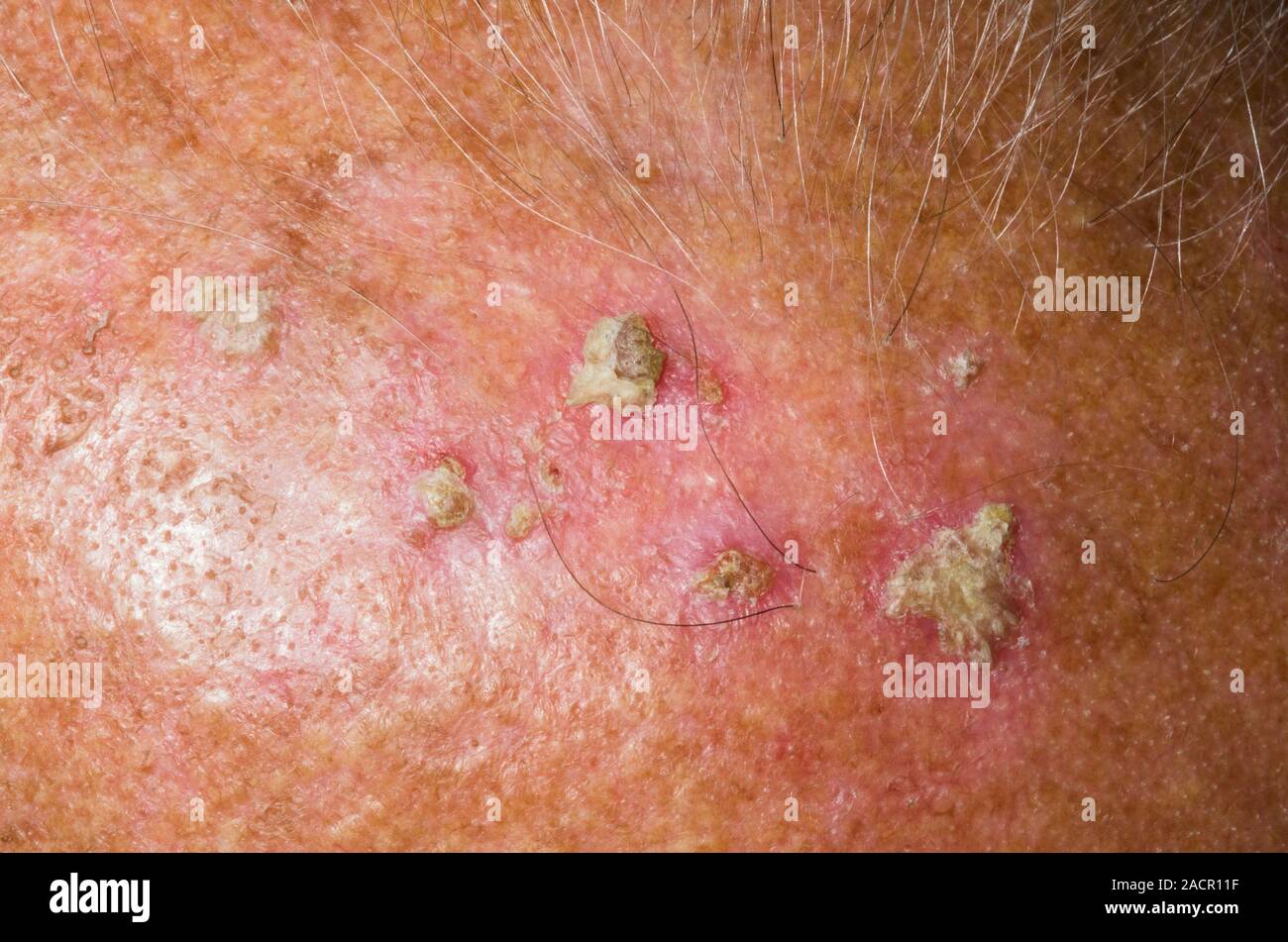 Close up Of Solar actinic Keratoses On The Scalp Of An 85 Year Old Close up Of Solar actinic Keratoses On The Scalp Of An 85 Year Old