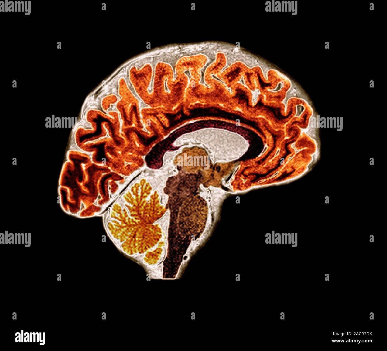 Brain. Coloured magnetic resonance imaging (MRI) scan of a sagittal ...