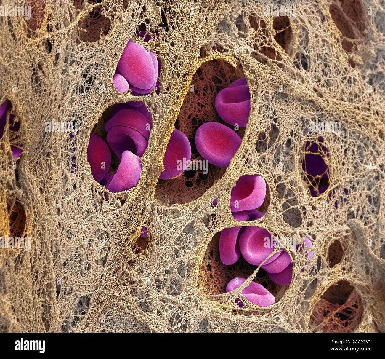 Coronary blood clot. Coloured scanning electron micrograph (SEM) of a ...