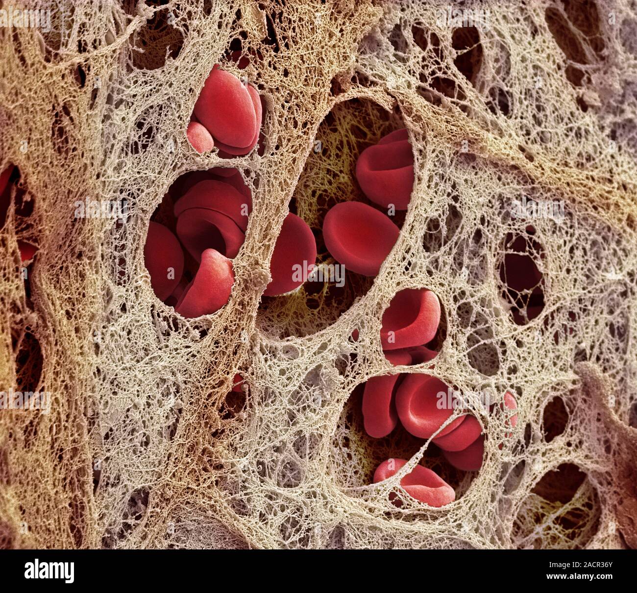 Coronary blood clot. Coloured scanning electron micrograph (SEM) of a blood clot (thrombus) in