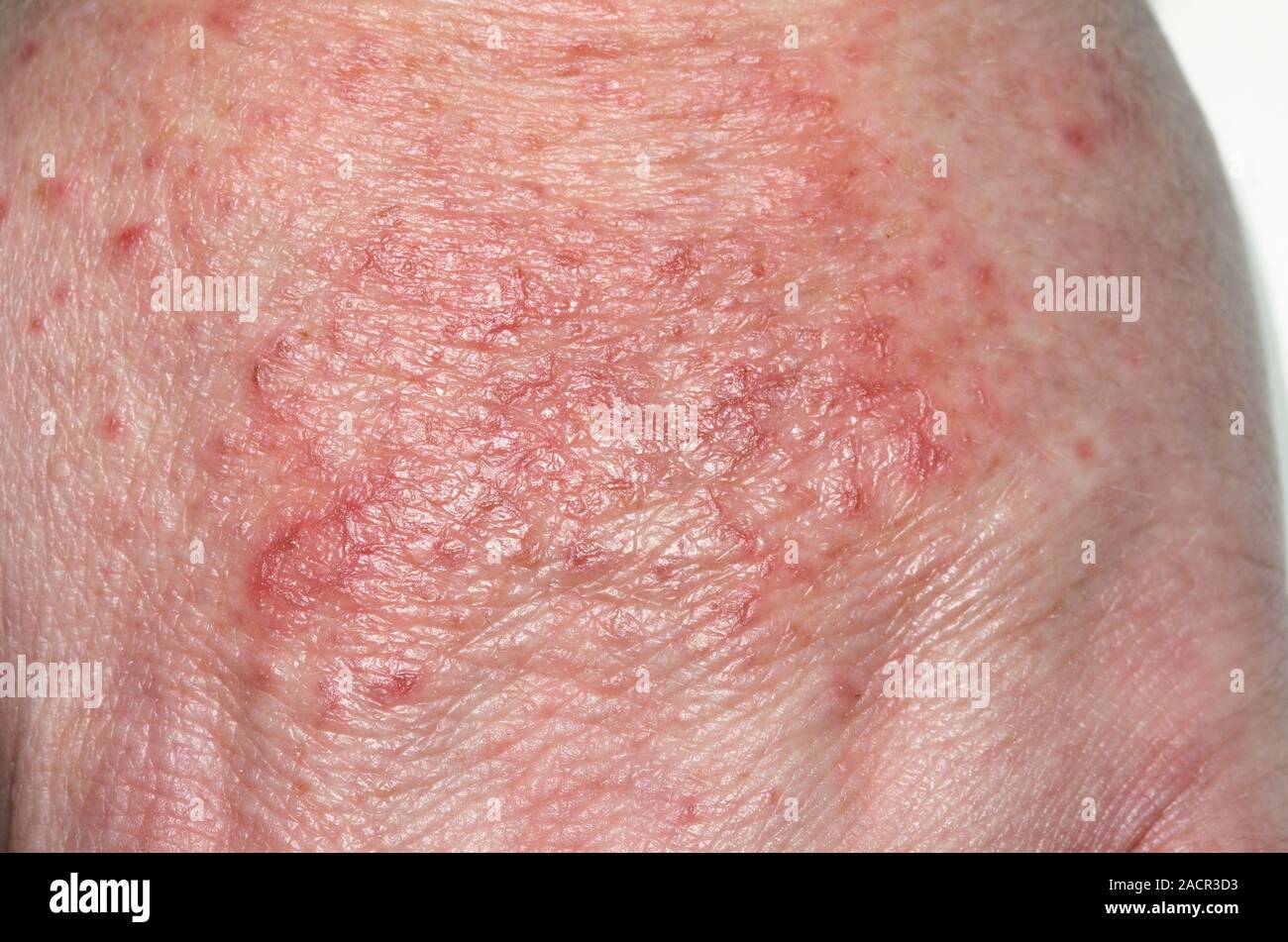 Closeup of a red rash on the hand of a 37 year old female patient, This is contact dermatitis