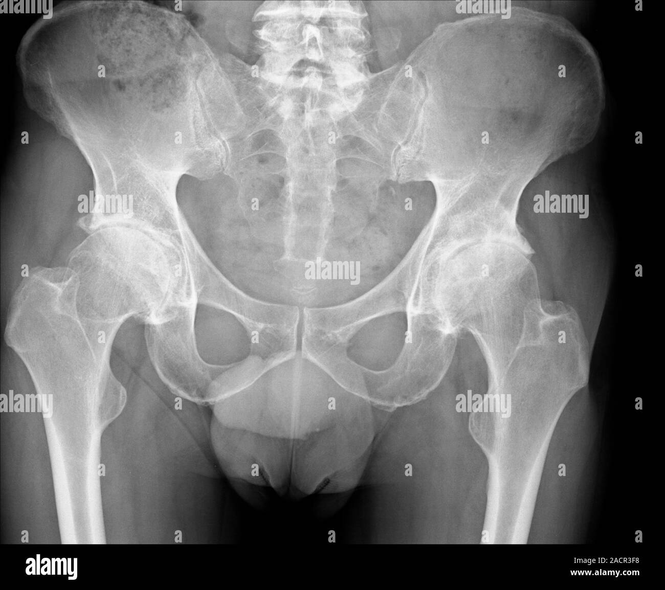 X-ray (front view) of the pelvis of a 64 year old male patient showing ...