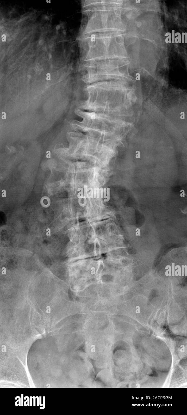 Xray (front view) of the torso of an 82 year old female patient
