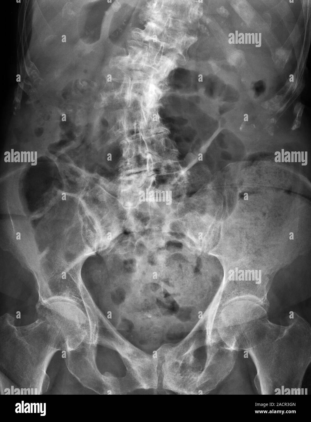 X-ray (front view) of the lower spine and pelvis of an 82 year old ...