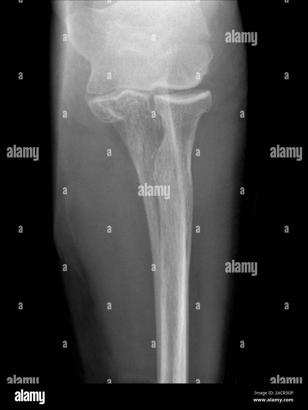 Xray (top view) of a fracture (upper centre) of the upper arm bone