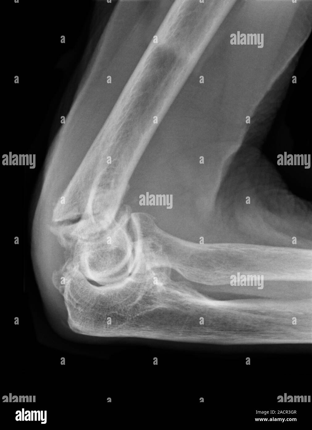 Xray (side view) of a fracture (centre left) of the upper arm bone