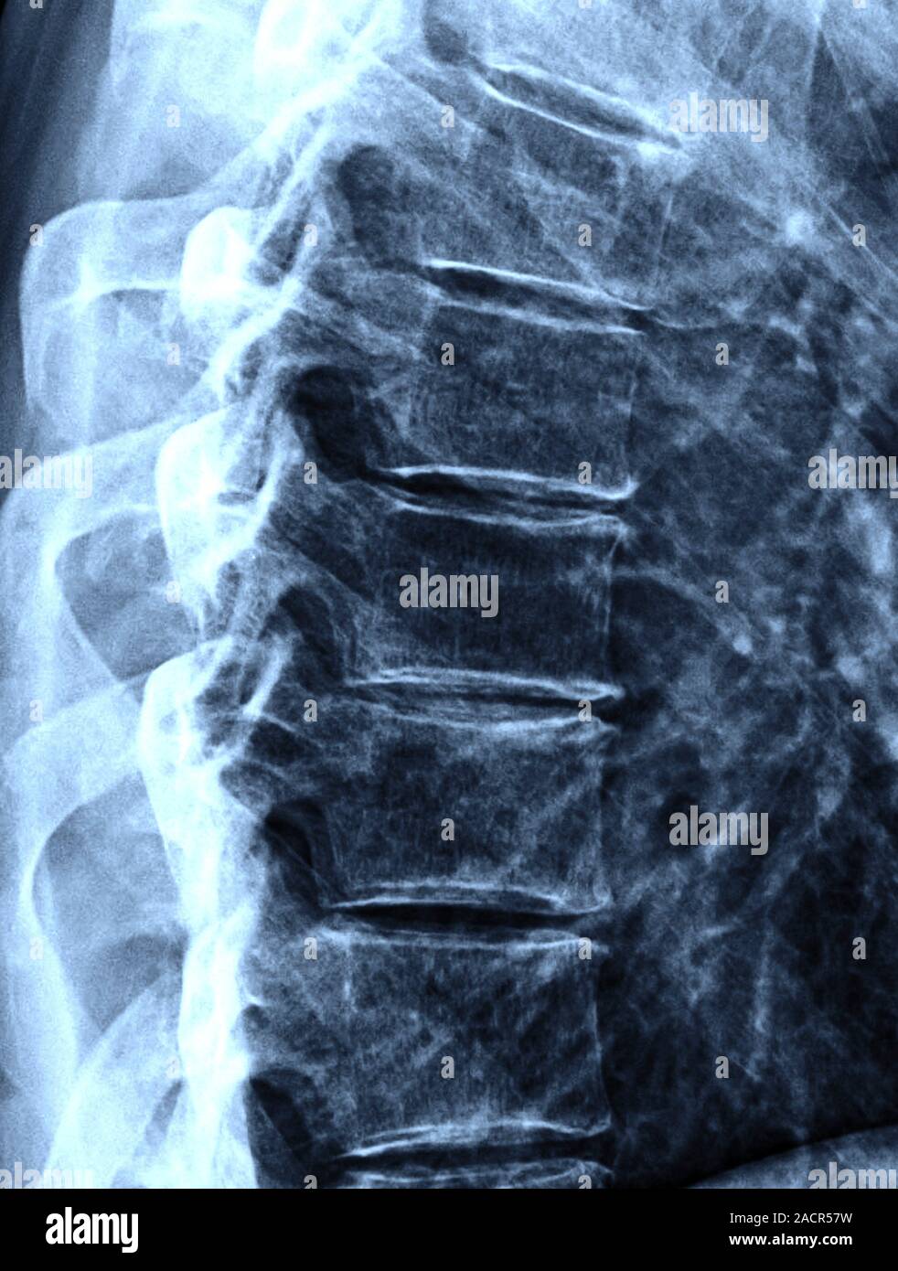 Osteoarthritis. Xray of the thorarcic spine of a 64 year old man with