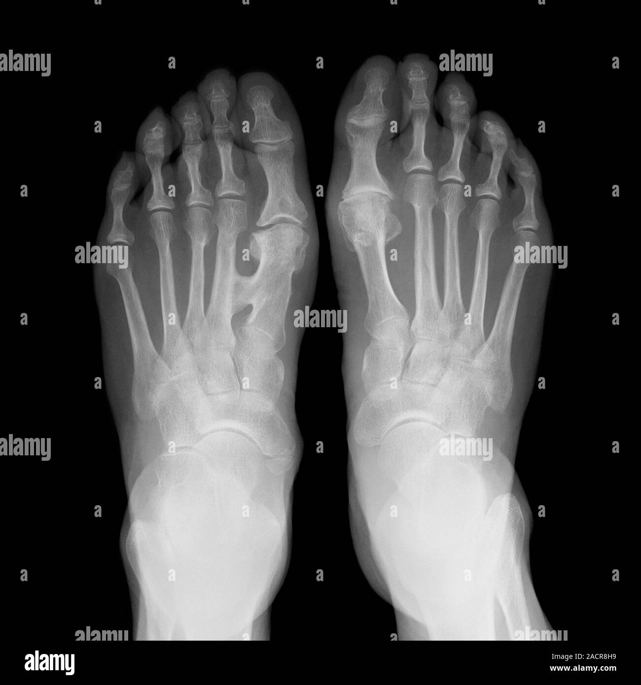 Fused metatarsals. X-ray of the feet of a 73 year old female patient ...