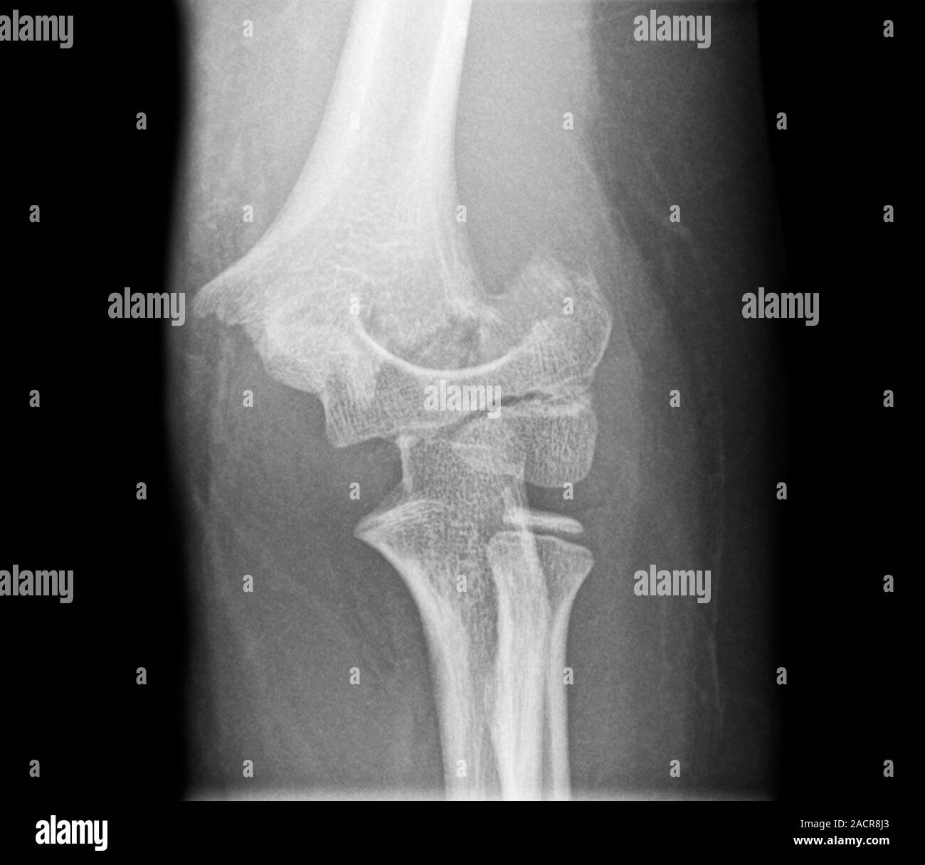 Fractured elbow. Xray of the fractured left elbow of a 9 year old boy