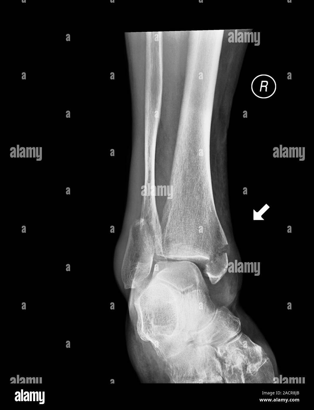 Broken ankle. Xray of the lower leg of an 85 year old female with