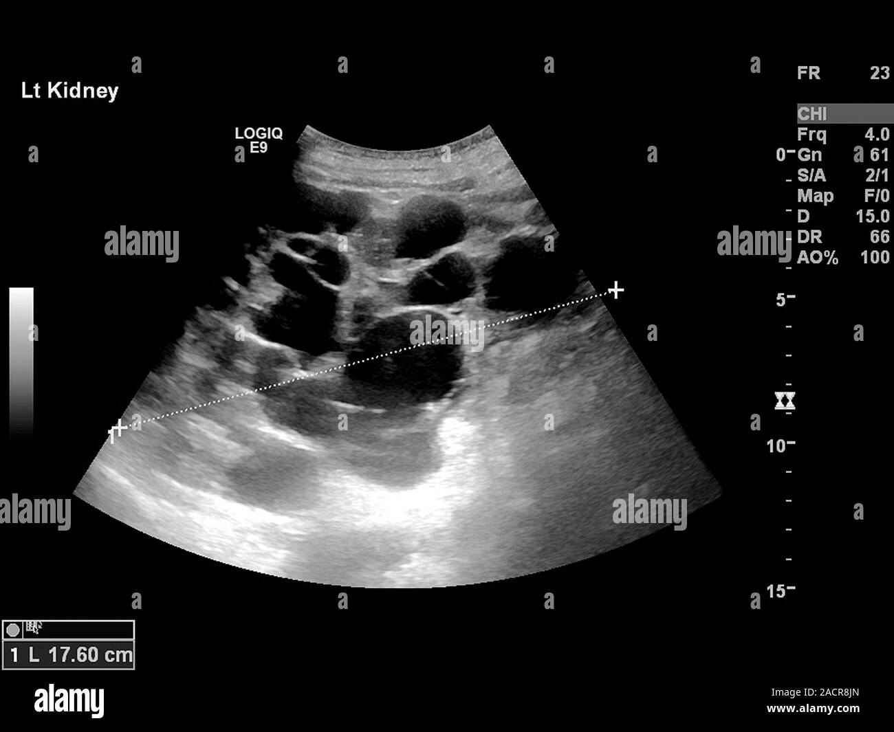 Polycystic kidney. Ultrasound scan of the kidney of an 82 year old male ...