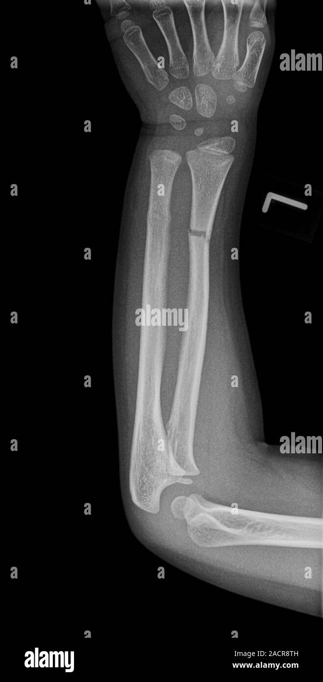 Broken arm. Xray of the lower arm of a 6 year old male showing a