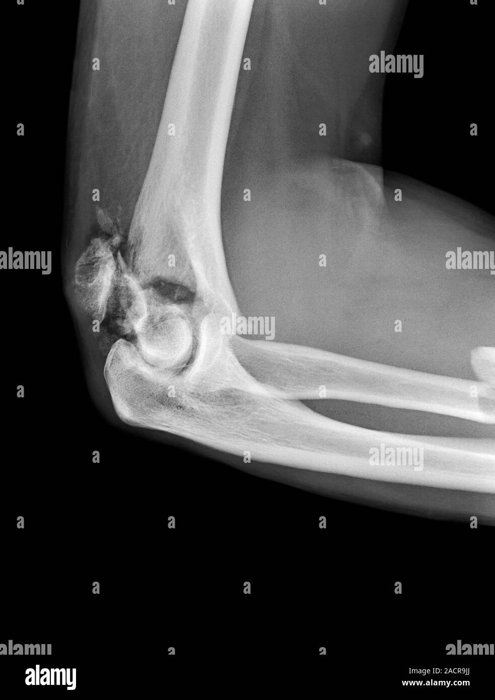 Broken elbow. Xray of the arm of a 55 year old male patient with fractures to the elbow and